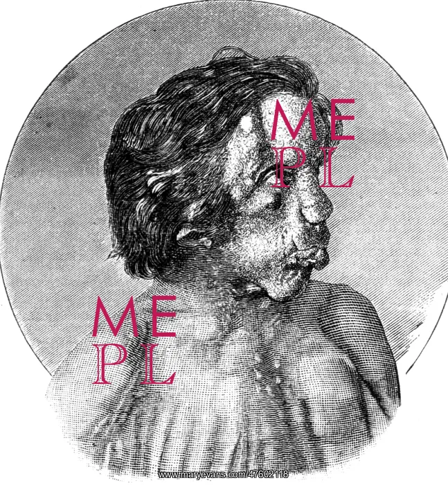 : Joseph Merrick, The Elephant Man : Joseph Merrick, The Elephant Man