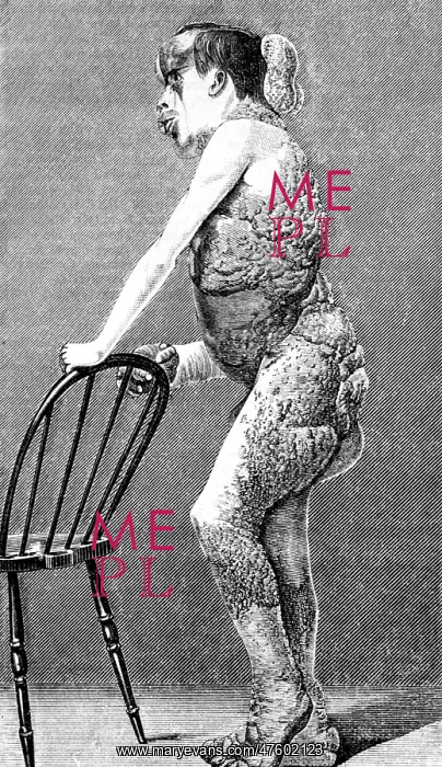 : Joseph Merrick, The Elephant Man : Joseph Merrick, The Elephant Man