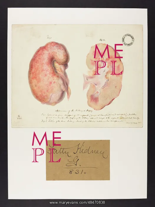  : Kidney in Dropsy