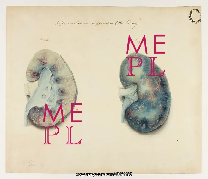 : Kidney: Inflammation and Suppuration : Kidney: Inflammation and Suppuration