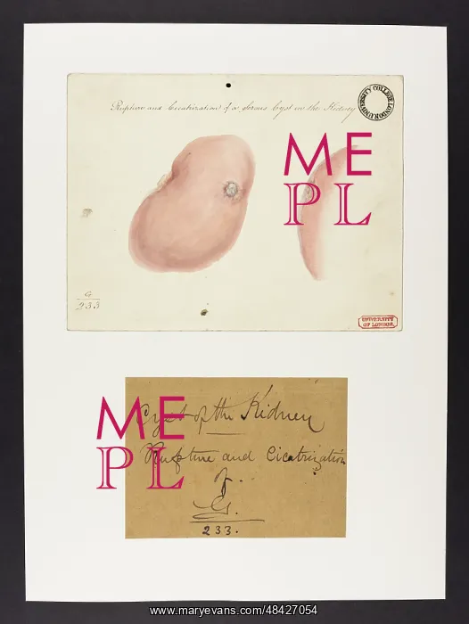 : Kidney: Rupture and Cicatrisation of a Serous Cyst : Kidney: Rupture and Cicatrisation of a Serous Cyst