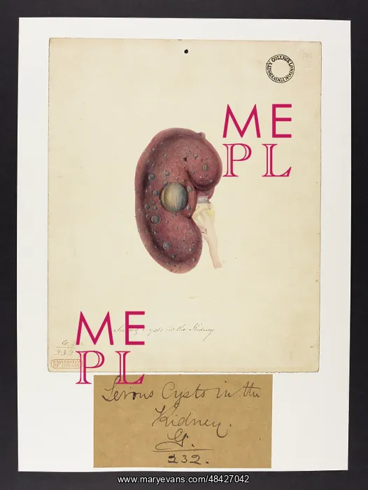 : Kidney: Serous Cysts : Kidney: Serous Cysts