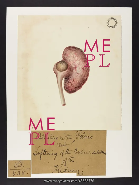 : Kidney: Softening of Cortical Substance : Kidney: Softening of Cortical Substance
