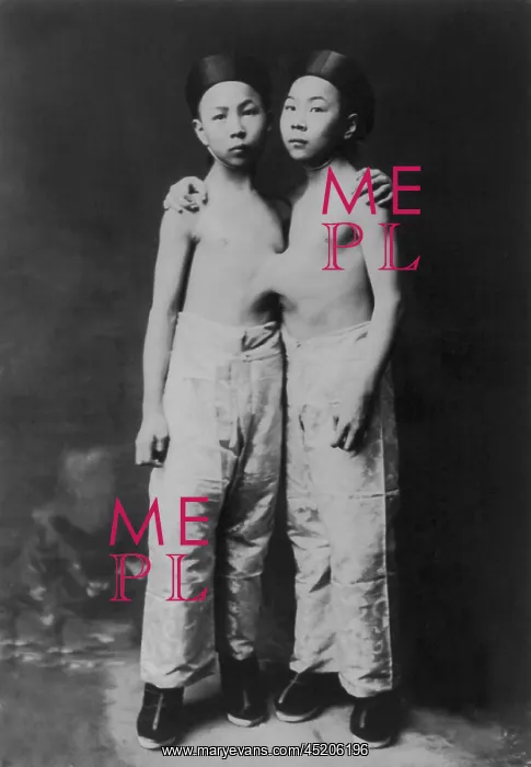 : Korean Siamese twins standing with hands ? : Korean Siamese twins standing with hands ?