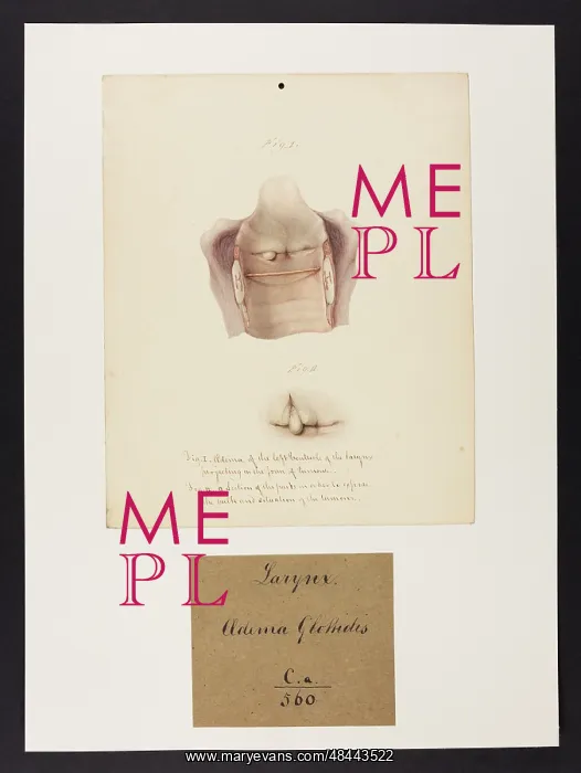  : Larynx: Oedema Glottidis