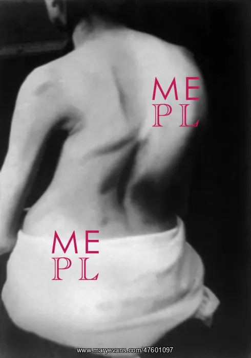 : Lateral Curvature of the Spine : Lateral Curvature of the Spine
