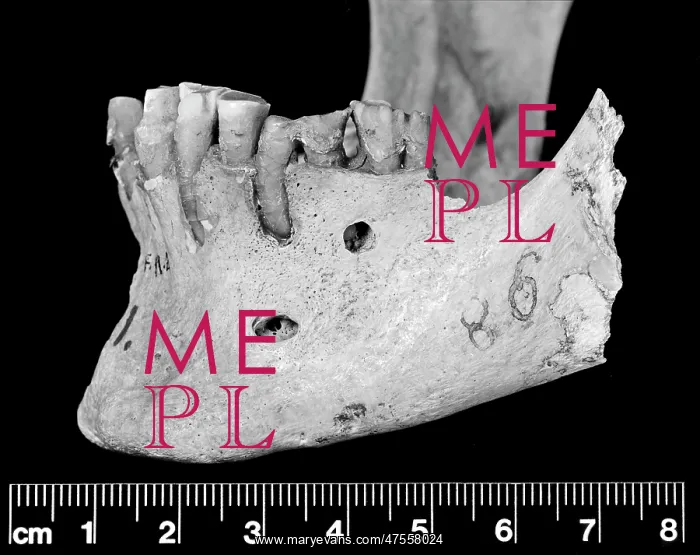 : Lateral view of mandible : Lateral view of mandible