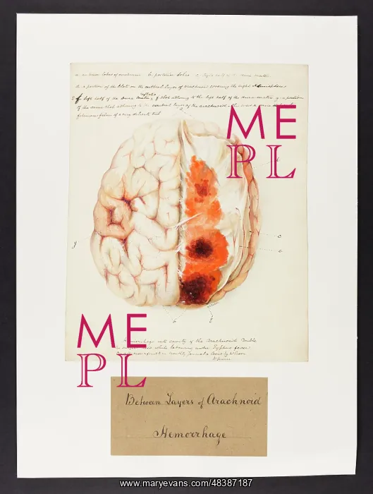 : Between Layers of Arachnoid: Haemorrhage : Between Layers of Arachnoid: Haemorrhage