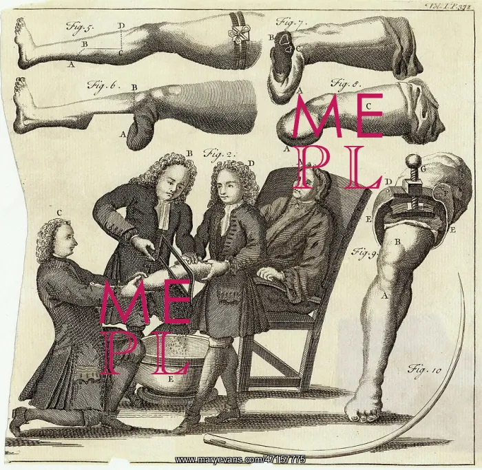 : Leg amputation : Leg amputation