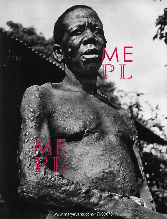 : Leprosy. Man with leprosy (Hansen's disease) : Leprosy. Man with leprosy (Hansen's disease)