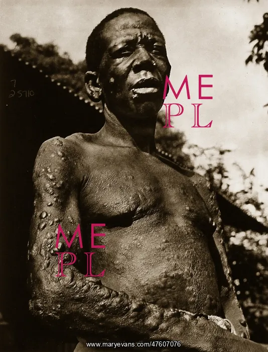: Leprosy. Man with leprosy. Mycobacterium leprae is the causative agent of leprosy : Leprosy. Man with leprosy. Mycobacterium leprae is the causative agent of leprosy