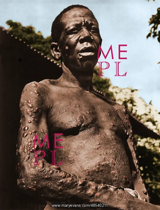 : Leprosy. Man with leprosy (Hansen's disease) : Leprosy. Man with leprosy (Hansen's disease)