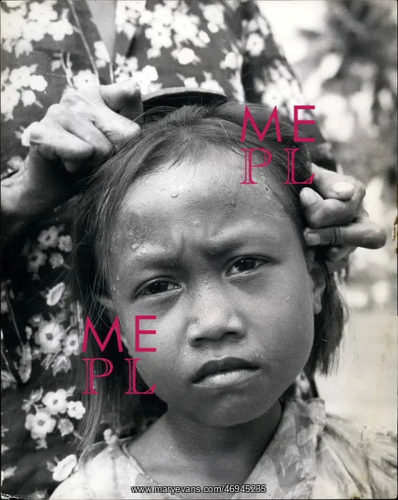 : Leprosy in Indonesia : Leprosy in Indonesia