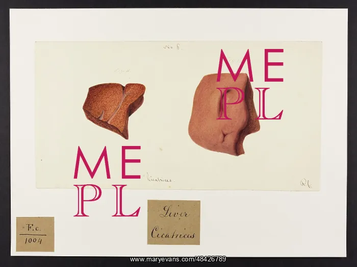 : Liver: Cicatrices : Liver: Cicatrices