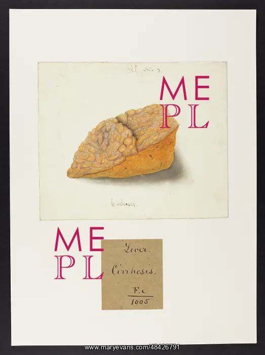 : Liver: Cirrhosis : Liver: Cirrhosis