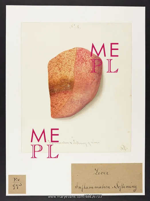 : Liver: Inflammation and Softening : Liver: Inflammation and Softening