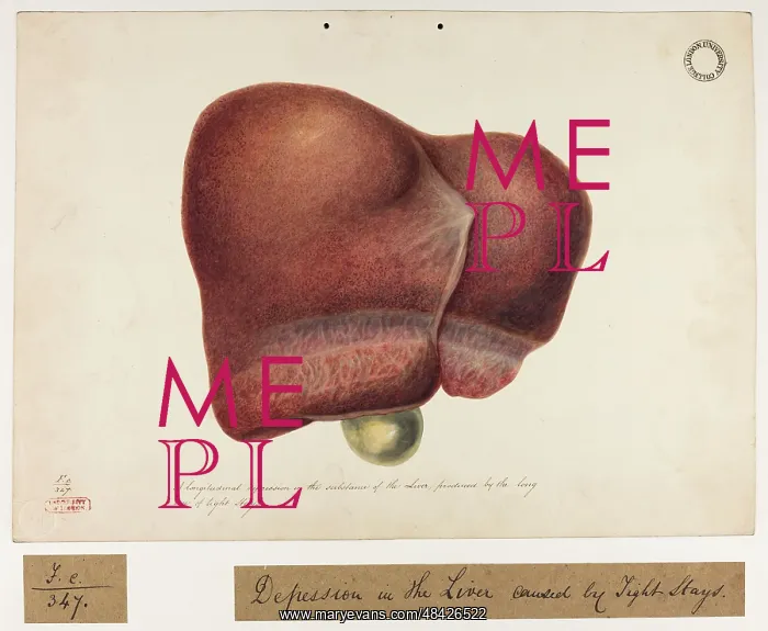 : Longitudinal Depression in the Substance of the Liver : Longitudinal Depression in the Substance of the Liver