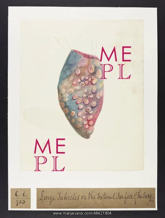 : Lung with Tubercles : Lung with Tubercles