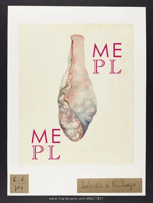 : Lung with Tubercles : Lung with Tubercles