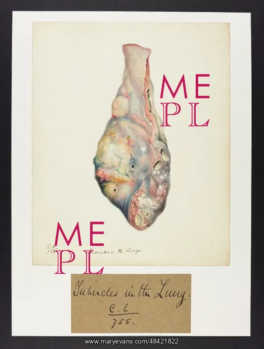 : Lung with Tubercles : Lung with Tubercles