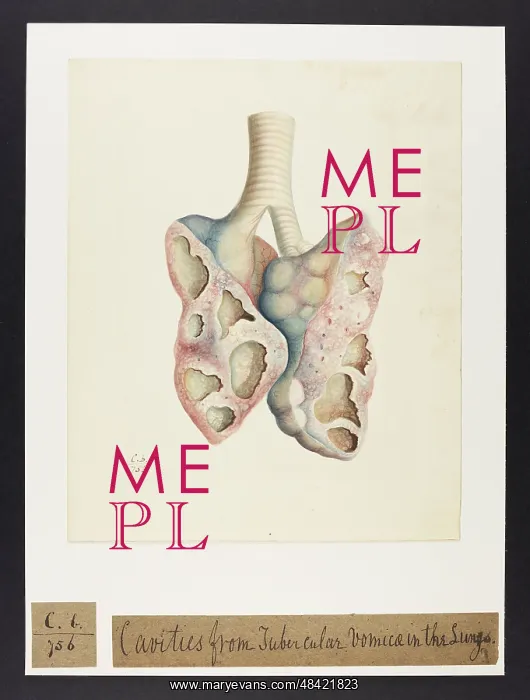 : Lungs with Tubercular Vomicae : Lungs with Tubercular Vomicae