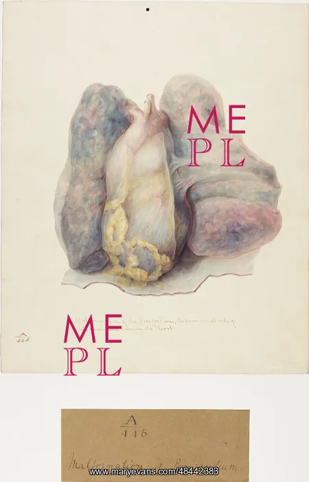 : Malformation of Pericardium : Malformation of Pericardium