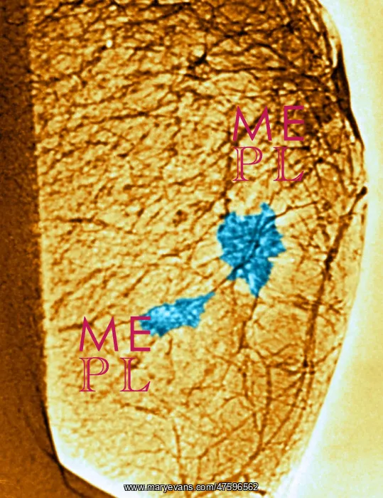  : Mammogram. Color enhanced mammogram showing tumors in the breast tissue