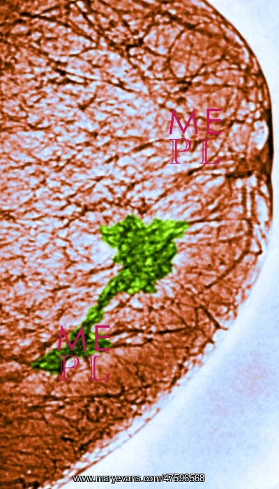  : Mammogram. Color enhanced mammogram showing tumors in the breast tissue