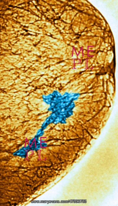  : Mammogram. Color enhanced mammogram showing tumors in the breast tissue