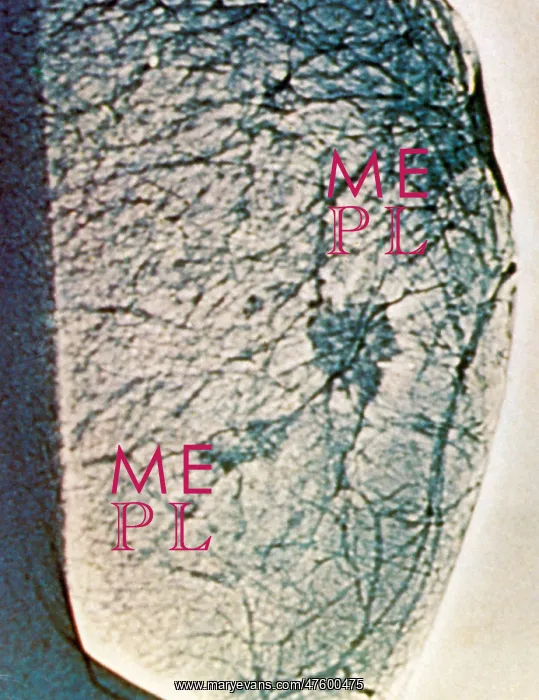  : Mammogram showing tumours in the breast tissue