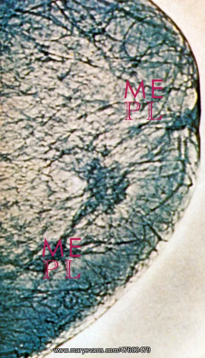  : Mammogram showing tumours in the breast tissue