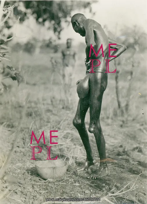: A man Mann - suffering from Elefantiasis (Lymphatic : A man Mann - suffering from Elefantiasis (Lymphatic