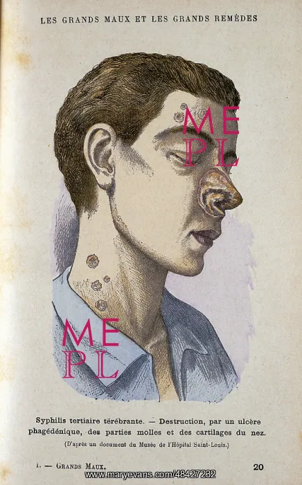 : Man suffering from tertiary Syphilis. From Jules : Man suffering from tertiary Syphilis. From Jules