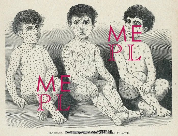 : Measles Compared : Measles Compared