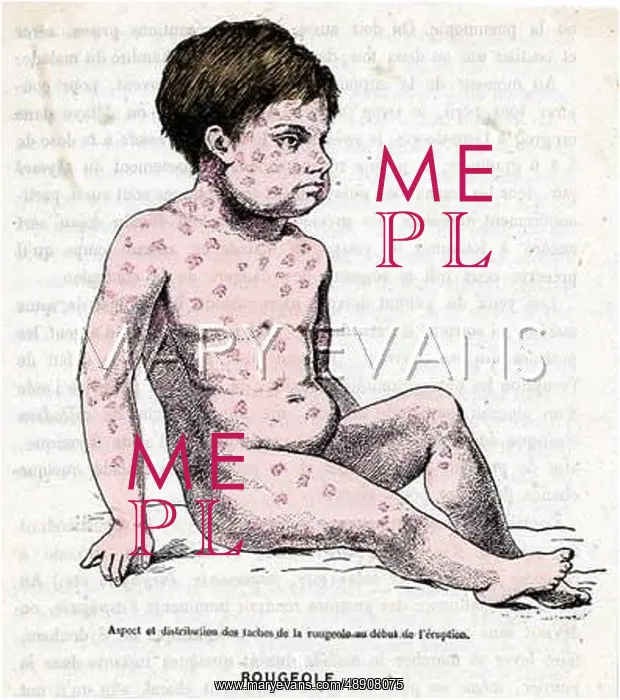 : A MEASLES SUFFERER : A MEASLES SUFFERER
