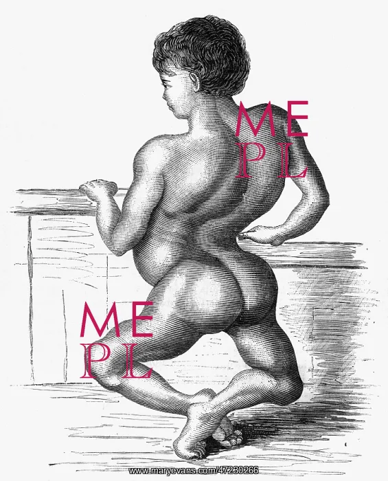 : MEDICAL / AILMENTS / RICKETS : MEDICAL / AILMENTS / RICKETS