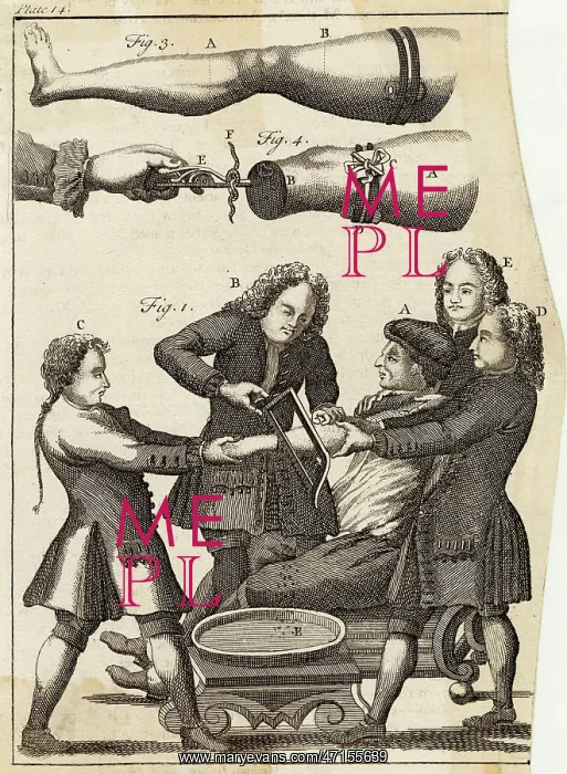  : MEDICAL / AMPUTATION / ARM