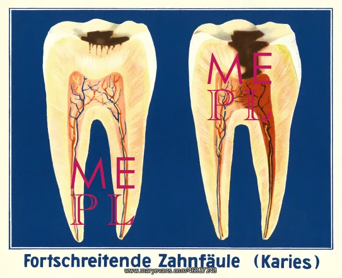  : medicine, dentistry, tooth decay, school chart