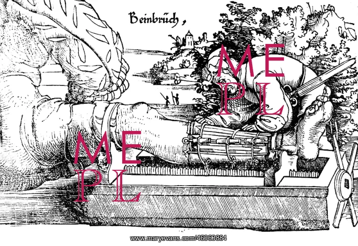 : medicine, surgery, fracture, splinting of a broken : medicine, surgery, fracture, splinting of a broken