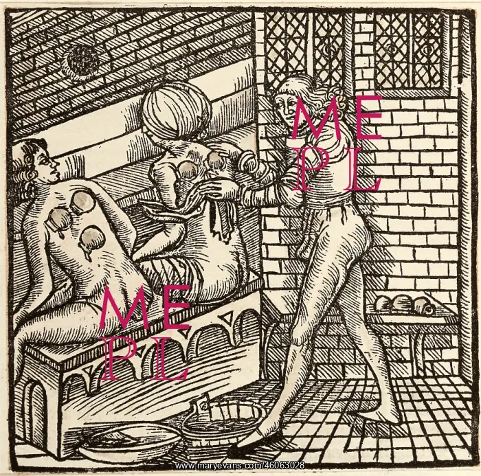 : medicine, treatment, fire cupping, woodcut, coloured : medicine, treatment, fire cupping, woodcut, coloured