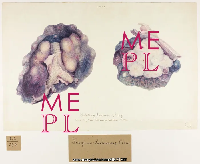 : Medullary: Sarcoma of Lungs and Pulmonary Vein : Medullary: Sarcoma of Lungs and Pulmonary Vein