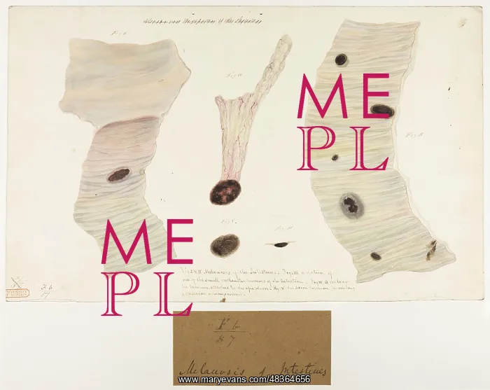 : Melanosis of Intestines : Melanosis of Intestines