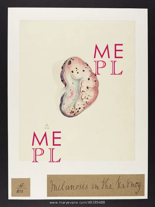 : Melanosis in the Kidney : Melanosis in the Kidney