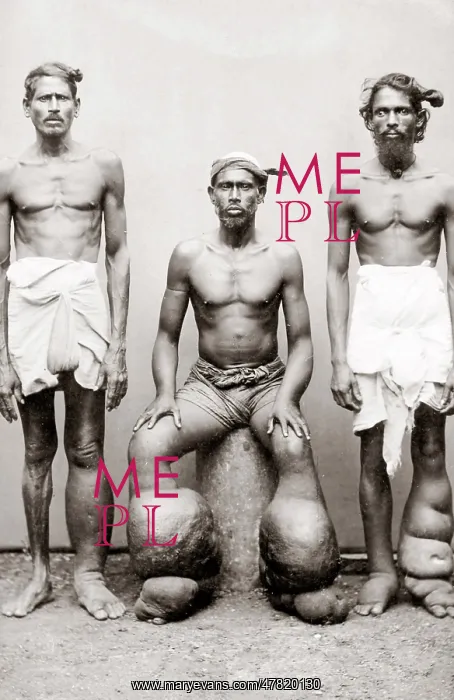 : Men with Lymphatic filariasis, or elephantiasis : Men with Lymphatic filariasis, or elephantiasis