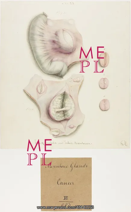 : Mesenteric Glands: Cancer : Mesenteric Glands: Cancer