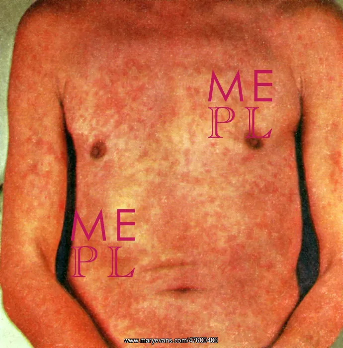 : Miliaria (also known as miliaria rubra, sweat rash : Miliaria (also known as miliaria rubra, sweat rash