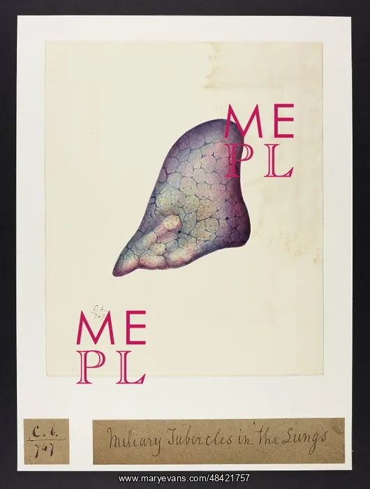 : Miliary Tubercles in Lungs : Miliary Tubercles in Lungs