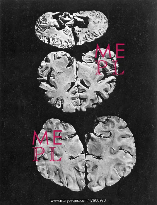  : Minamata Disease