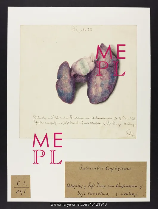 : Monkey: Tubercular Emphysema and Atrophy of Lung : Monkey: Tubercular Emphysema and Atrophy of Lung