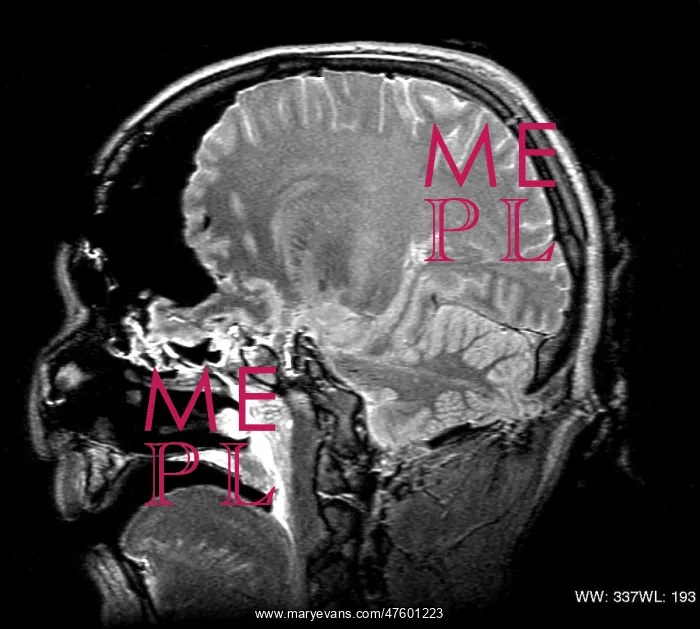 : MRI Cross Section, Wound Track : MRI Cross Section, Wound Track